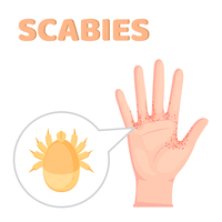 Skabies